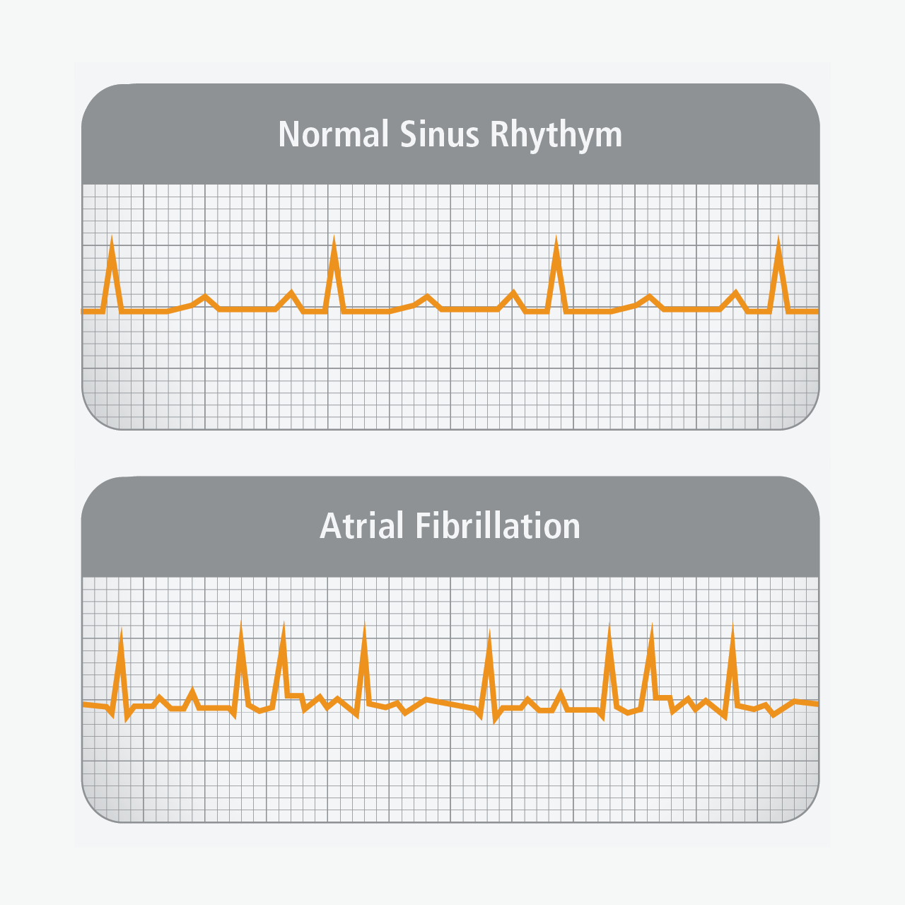 What Is Atrial Fibrillation? | Get Smart About AFIB